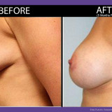 Breast Augmentation Side
