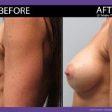 Breast Augmentation Front After 5 Weeks