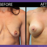 Breast Augmentation Front After 5 Weeks