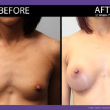 Breast-Augmentation-001-front