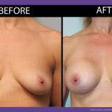 Breast-Augmentation-002-front