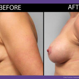 Breast-Augmentation-002-side