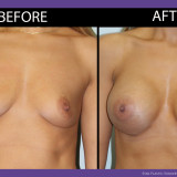 Breast-Augmentation-003-front