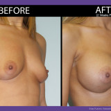 Breast-Augmentation-003-side