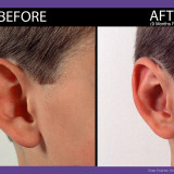 Ear-Surgery-001-Side