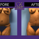 Revision of Botched Tummy Tuck by Another Surgeon