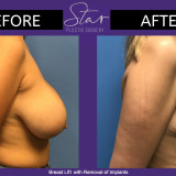 Breast Lift with removal of implants 01