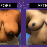 Breast Reduction 2/22