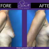 Breast Augmentation and Lift 2023
