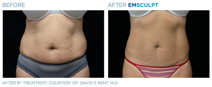 EMSCULPT BEFORE AND AFTER