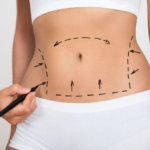 Benefits of the Drainless Tummy Tuck