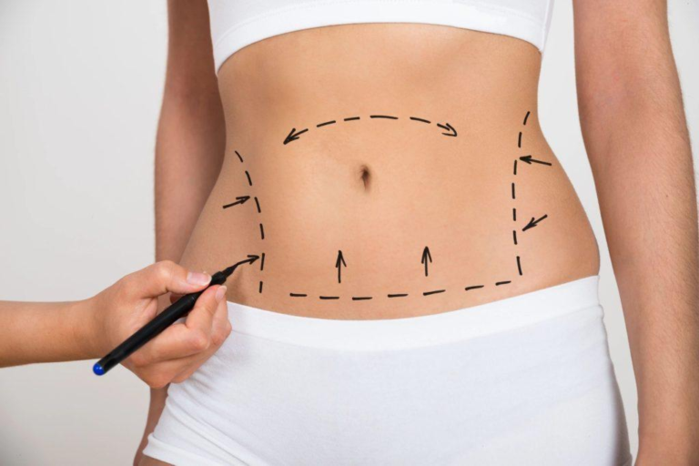 Benefits of the Drainless Tummy Tuck