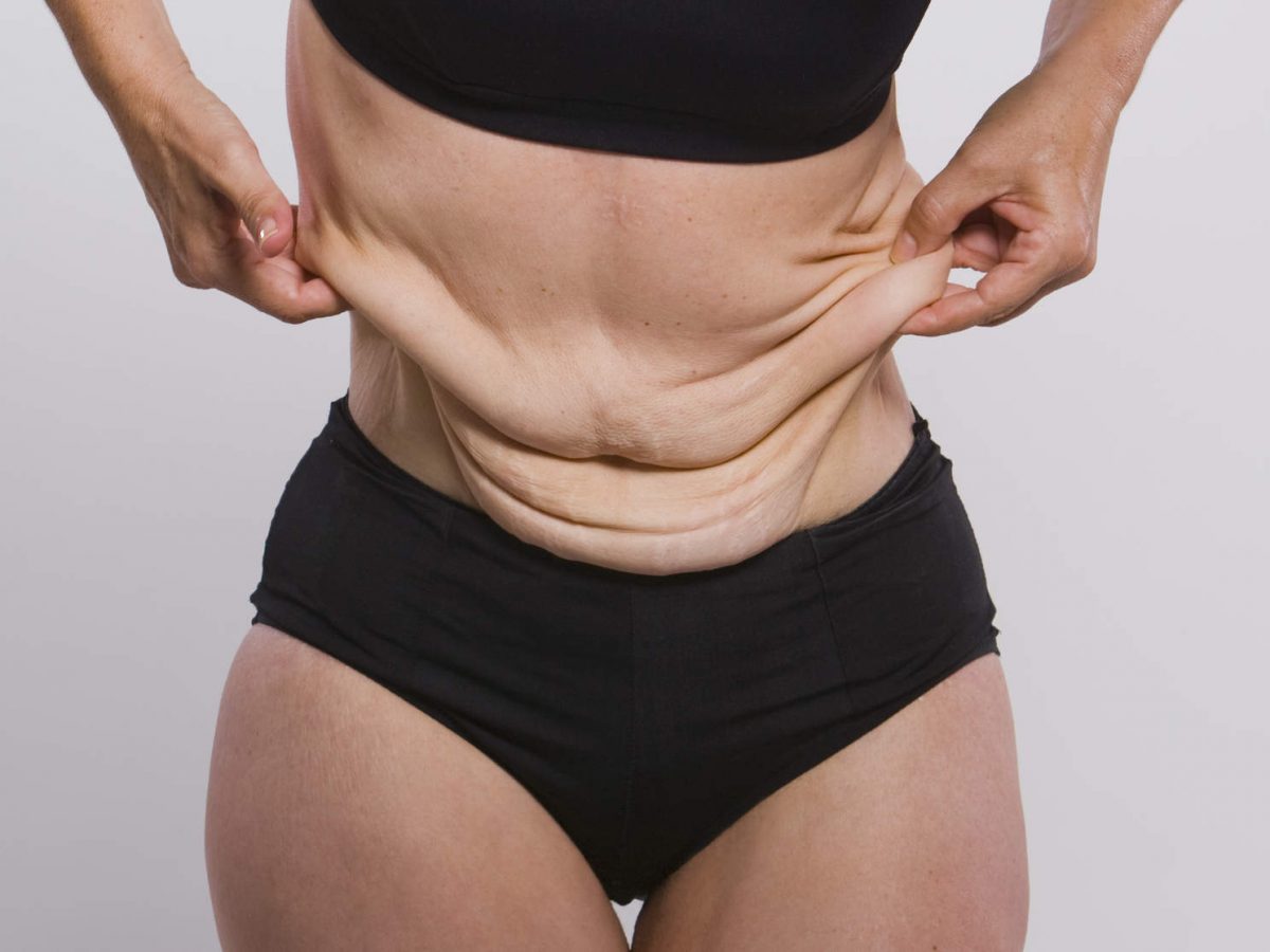 Improving Loose Skin After Massive Weight Loss