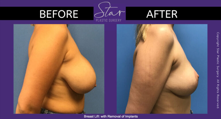 Breast Lift with removal of implants