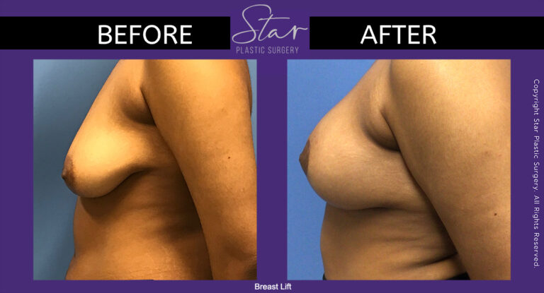 Breast Lift - Before and After - Star Plastic Surgery Michigan