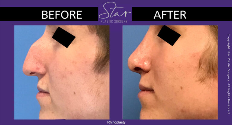 Rhinoplasty - Nose Job - Before and After - Star Plastic Surgery - Novi, Michigan - Dr. Elan Reisin